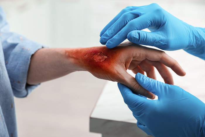 Doctor examining terrible patient's burnt hand