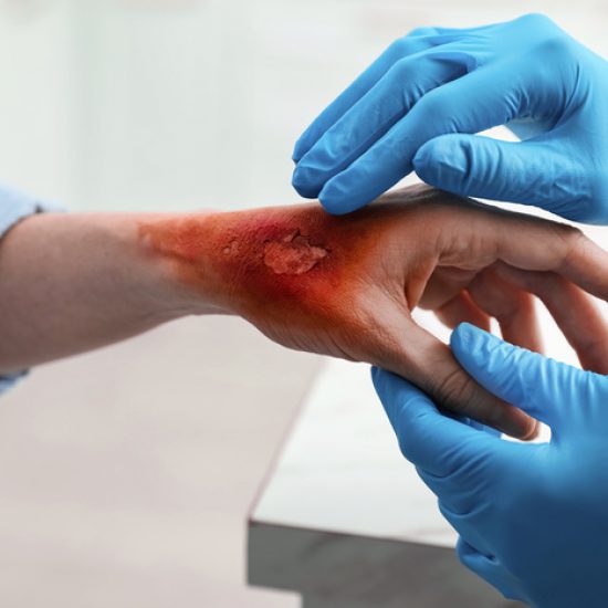 Injured in a Fire? Here's Why You Need a Burn Injury Attorney